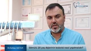 Gömülü 20 yaş dişlerinin tedavisi nasıl yapılmalıdır