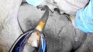 DENTIST EXTRACTS ALL UPPER TEETH DURING CRAZY IMMEDIATE DENTURE PROCEDURE!