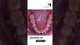 How does orthodontics treat crowded teeth?  #dentist #orthodontics #lower_incisor#orthodontist