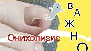 Онихолизис - это важно знать !