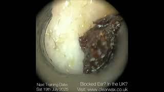 330 - Dark Blocked Ear Wax Removed from Super Narrow Ear Canal Entrance using the WAXscope®️
