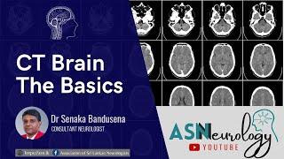 Neurology Basics - CT Brain by Dr Senaka Bandusena