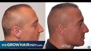 ARTAS Robotic FUE Hair Transplant 4 Month Results - Alex