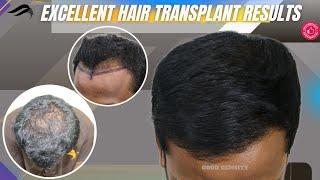 Hair Transplant In Shimoga | Best Clinic Cost Surgeon & Results Of Hair Transplant In Shimoga