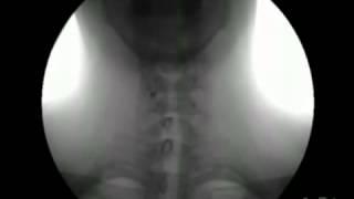 X Ray of Peristalsis in Esophagus