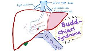 Budd-Chiari syndrome - Definition, Causes, Pathophysiology, Diagnosis & Treatment - Hepatology