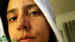 Acne & Cancer Connection
