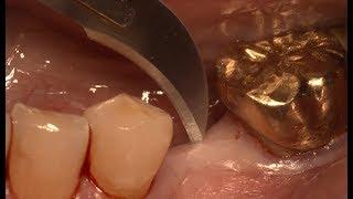 Minimally invasive implantation using New SuperLine