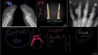 JOINT DISEASES OF HAND "HOW TO APPROACH RADIOLOGICALLY WITH BASIC THOUGHT PROCESS