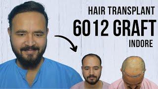 6012 Graft Hair Transplant in Indore | Best Results & Cost of Hair Transplant in Indore