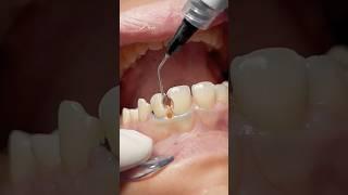 Composite restoration for anterior teeth #dentist