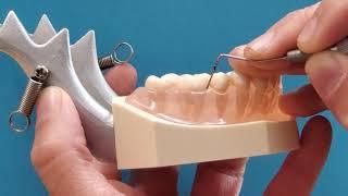 Periodontal Probing Posterior Tooth