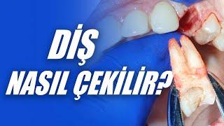 Diş Nasıl Çekilir? Diş Çekilirken Nelere Dikkat Edilmelidir? Diş Çekimi Nasıl Yapılır?