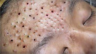 ACNE CLEANING - KINISH TV  #kinishacne #5