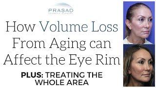 How Volume Loss Due to Aging Can Accentuate the Eye Socket, and Treatment for this Area