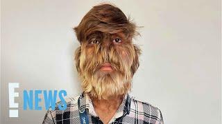 Lalit Patidar, 18, Sets Guinness World Record for Hairiest Face | E! News