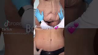 Amazing Full Body Lift Transformations: Before and After | TikTok Doc Reveals Incredible Results