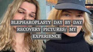 BLEPHAROPLASTY AND UPPER EYELID SURGERY RECOVERY, BEFORE&AFTER MY EXPERIENCE