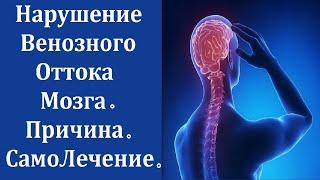 Венозный Отток Головного Мозга. Причина Нарушения. Лечение. Самолечение.