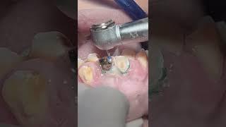 Anterior teeth Deep caries #dentist
