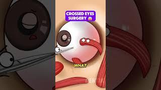Crossed Eyes FIXED with Surgery?!  | Strabismus (Hypertropia) Explained