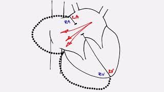 Adult Congenital Heart Disease: Atrial Septal Defect