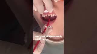 Dental crowns | porcelain crowns | #cosmeticdentistry #veneers Dr. Yazdan | dental crowns procedure