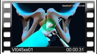 DynaMesh®-SIS direct - Animation: SUI Treatment - Transobturator (out/in) - TOT