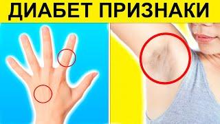 Как начинается ДИАБЕТ? 25% людей даже НЕ ЗНАЮТ о том, что имеют ДИАБЕТ. Как предотвратить ДИАБЕТ?