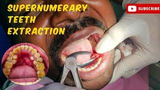 Multiple Supernumerary Teeth Extraction: Hyperdontia #viralvideo #youtubevideo #toothextractions