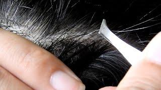 Satisfying ingrown hair - Pulling Juicy Gray Hair Part 35