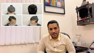 Cult Aesthetics Case Study 7: Hair Transplant By Dr. Gaurav Solanki [Call - 9990449555]