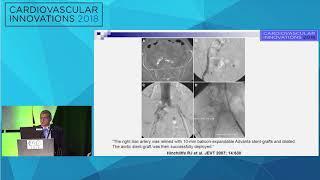 CVI2018 Session: How to manage nondilatable heavily calcified iliacs - Nicolas Shammas, MD