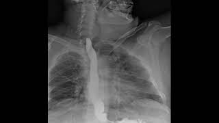 Dynamic Digital Radiology Retrospective View of Esophagus: Esophagogastroduodenoscopy (SEGD) part 4