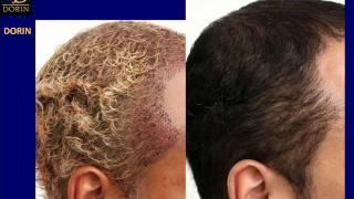 Temple Peak and Angular Alopecia Hair Transplant by Dr. Dorin