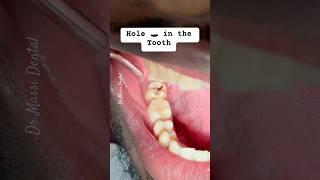 Is HOLE in the Tooth called Cavity ?
