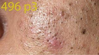 Make your Acne Treatment Huong Da Nang#496 | acne 2022 Part3