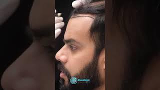 Hair Transplant Surgery in Turkey