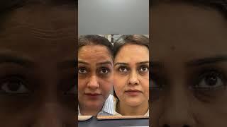 BOTOX for Face | Dr. Pragati Shubha