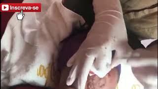REMOVENDO ESPINHAS E CRAVOS DO ROSTO - REMOVENDO CRAVOS E  ESPINHAS GIGANTES