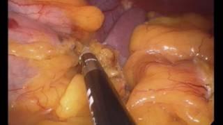 sleeve  gastrectomy by Wael Tobar MD