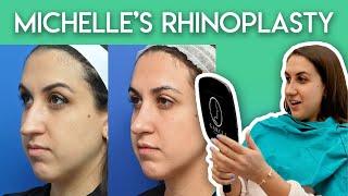 Michelle's Rhinoplasty Journey