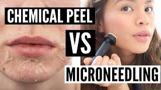 Chemical Peel VS Microneedling