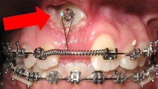 Unexpected orthodontic impaction and OPEN BITE timelapse. HOW BRACES WORK.