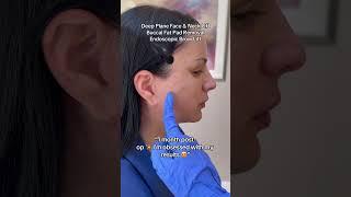 Facelift Recovery #faceliftbeforeandafter #facelift #nycfacelift #njfacelift #transformation #viral
