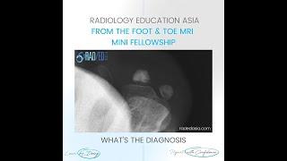WHAT'S THE Dx: SESAMOID AVN OSTEONECROSIS FRACTURE RADIOLOGY FOOT