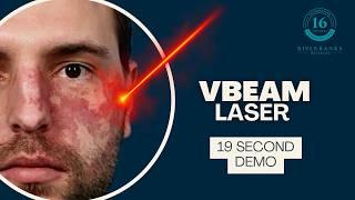 VBEAM Laser Treatment Demo for Flawless Results | Real-Time Laser Sound Effects!