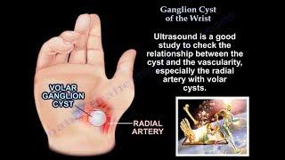 Ganglion Cyst Of The Wrist - Everything You Need To Know - Dr. Nabil Ebraheim