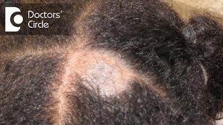 What causes Scalp Ringworm?| Effective Treatment | | Tinea Capitis - Dr. Tina Ramachander