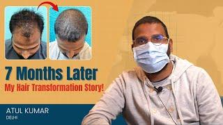 7 Months Later - My Hair Transformation Story | Atul Kumar, Delhi | SkinQure